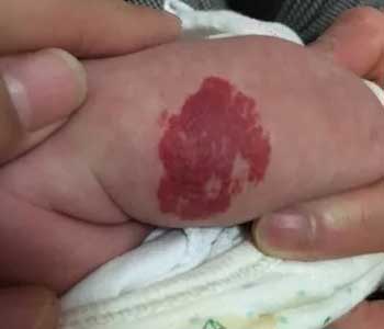 Ӥ�׶����Ѫ�������ɺ���