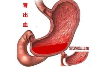 ����θ��Ѫ����ô����