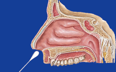 5厘米后,将药棉的尾部抬高,与地平面呈10°角推入鼻腔,深度一般为5—6
